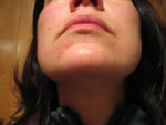 Day 5 peel 2